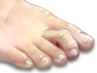 Hammertoes