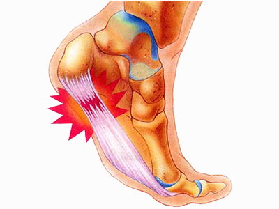 Heel Pain