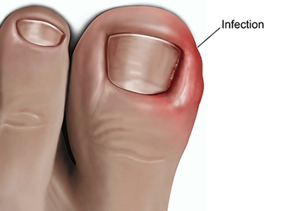 Ingrown Toenails